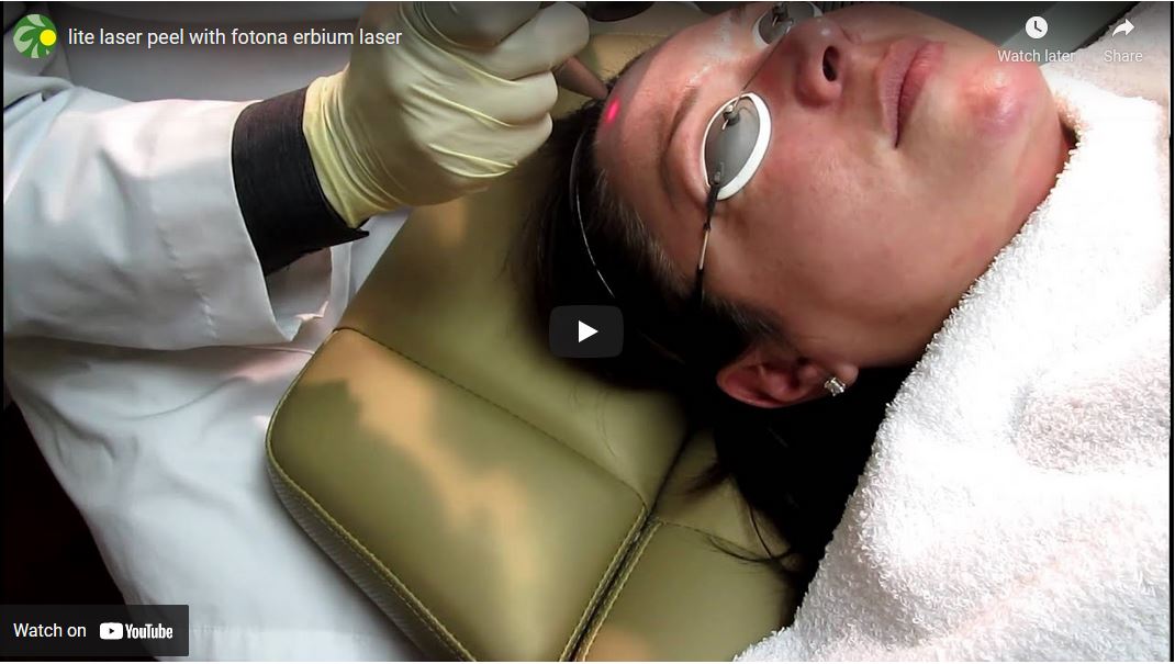 video-laser-peel