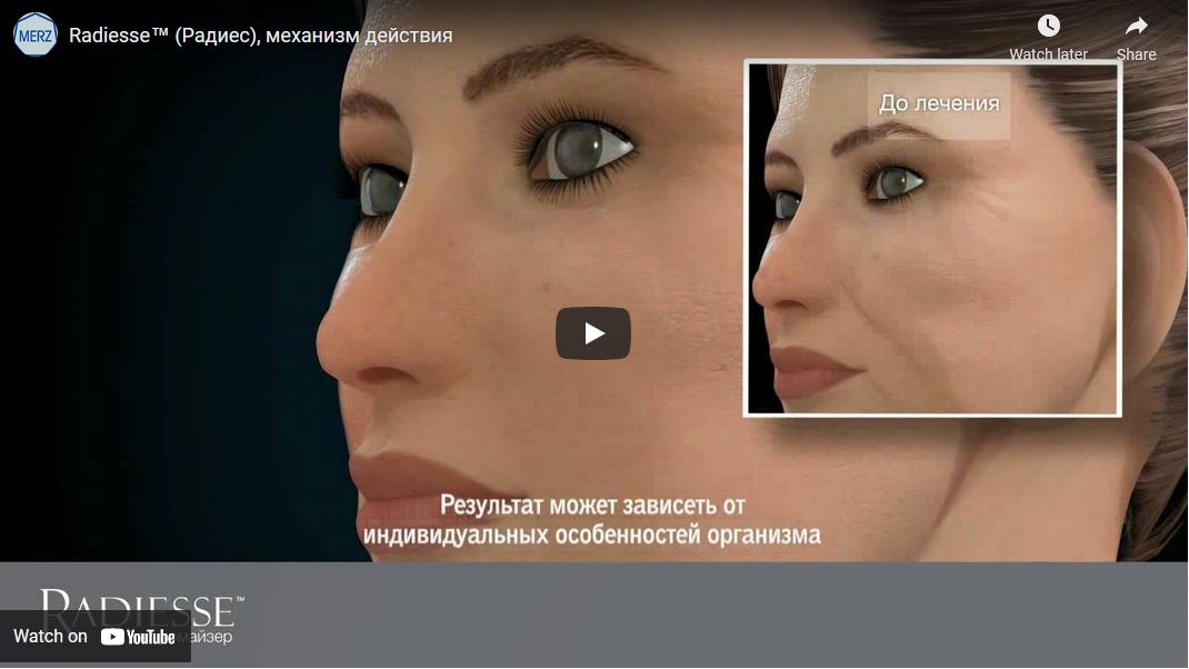 video-radiesse-ru