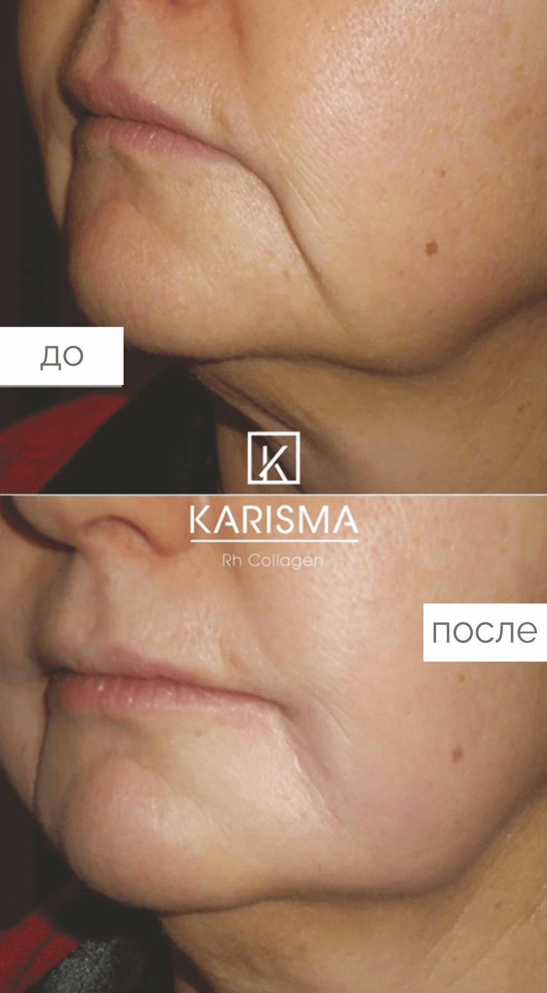 kariama_enne_parast1 Биостимуляция лица