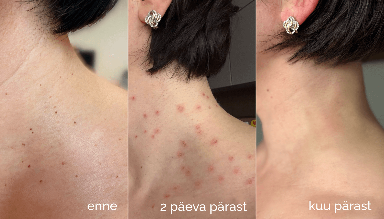 Papilloomide eemaldamine laseriga 