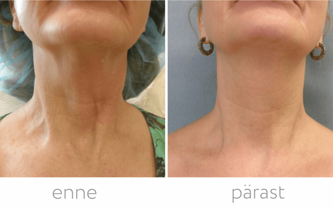 Meso-Radiesse®